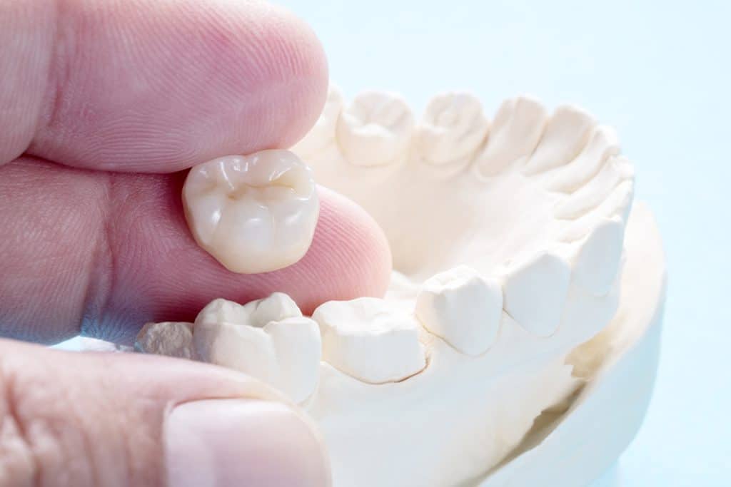 5 Signs Your Dental Crown May Need to Be Replaced