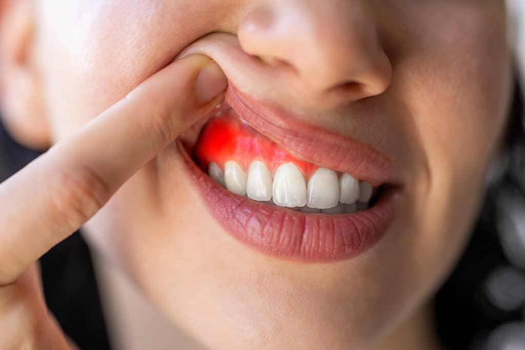 Early Warning Signs of Gum Disease You Shouldn't Ignore
