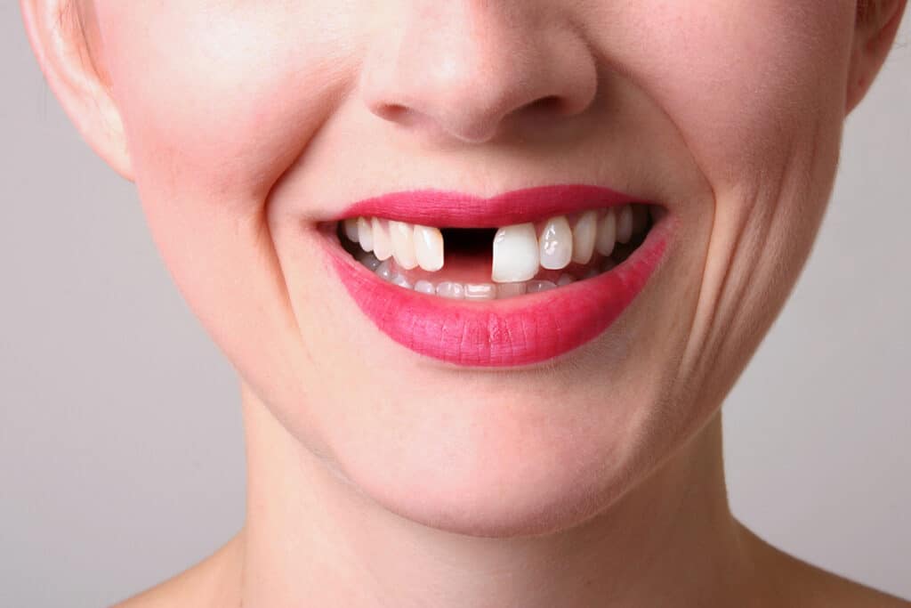 How Missing Teeth Affect Your Bite If Left Untreated