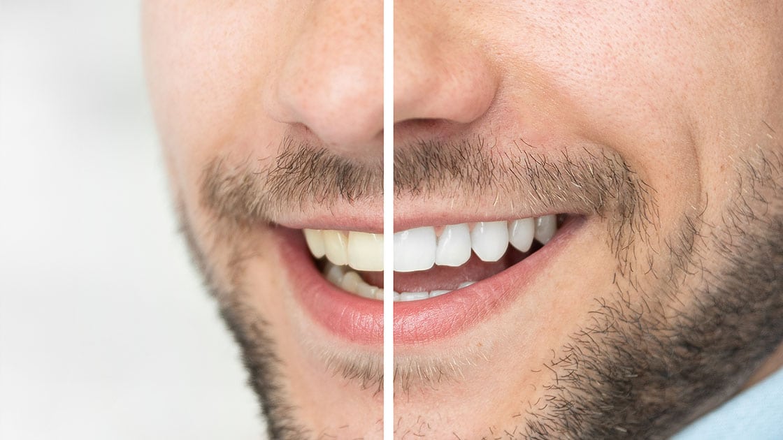 Man with teeth comparison