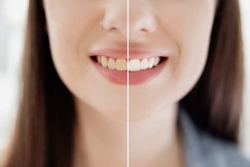 Smile Makeover Before and After: What Results Are Realistic?