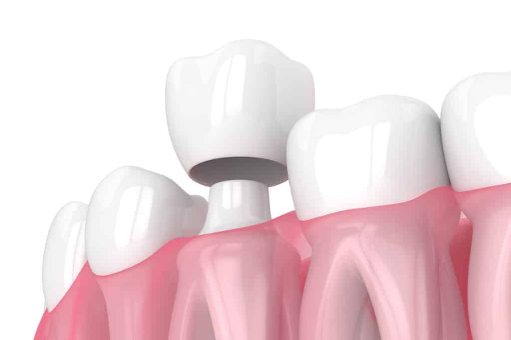 Temporary vs. Permanent Crowns: What to Expect in Between