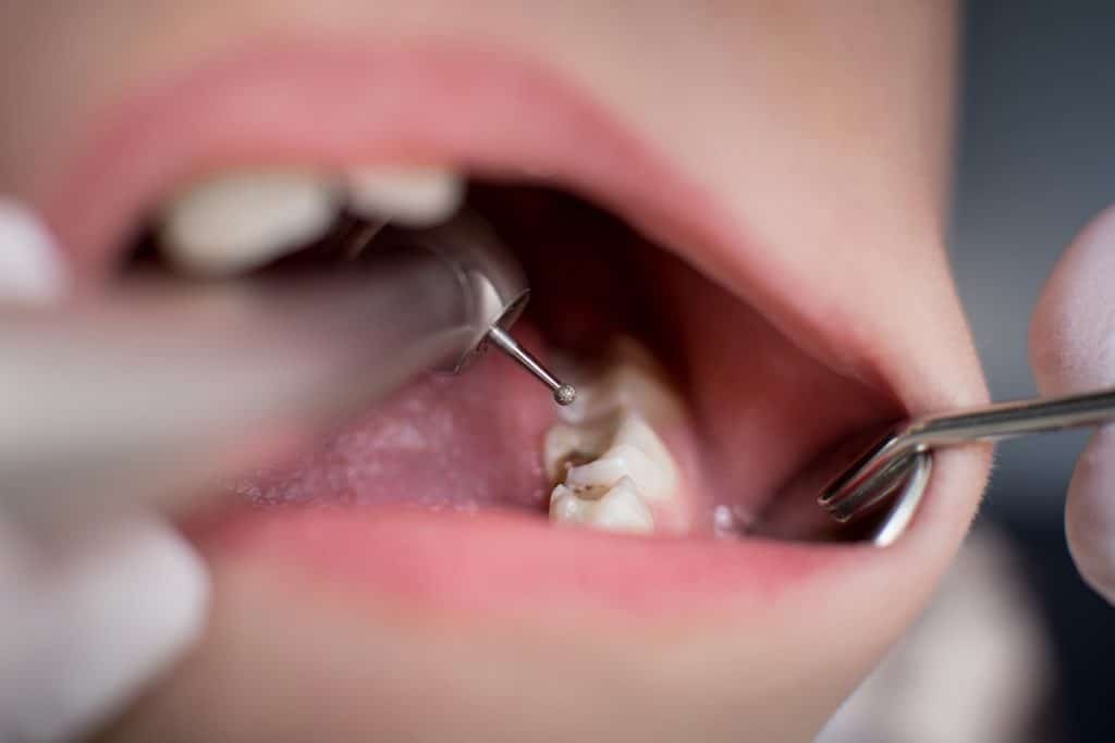 Tooth-Colored Fillings vs. Silver Fillings: Which Is Better for Your Teeth?