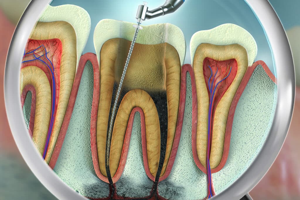 What Happens If You Delay a Needed Root Canal?